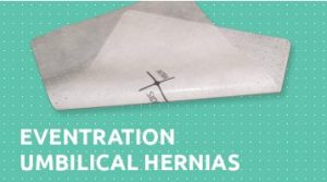 Eventration umbilical hernias